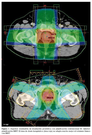 Fig. 2. Técnica de Radioterapia 3D. Se utilizan varios campos de tratamiento y las dosis en OARS son muchos más altas y por lo tanto con mayor riesgo de complicaciones. (Técnica en desuso). Al comparar con las figuras previas, la dosis en rojo sobre la próstata está menos conformada, o sea es un cuadrado en vez de presentar la morfología de la próstata, lo que hace que lleguen mayores dosis sobre los órganos de riesgo como el recto y la vejiga.