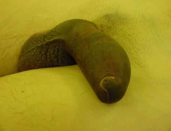  Fig,15. Fractura de Pene