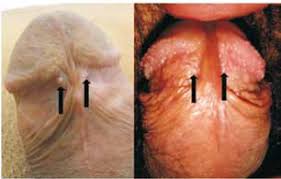 Fig. 2 y 3. Pápulas perladas y glándulas de Tyson.