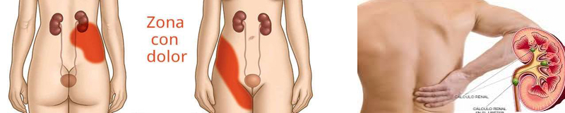 Fig 1 Cólico renal: a. Posición anti-álgica. b. Irradiación típica