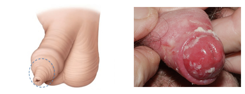 Fig. 6. Pene Fimótico. Lesiones neoplásicas de pene