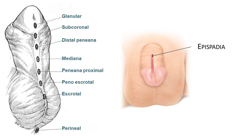 Fig. 7. Pene Fimótico. Lesiones neoplásicas de pene