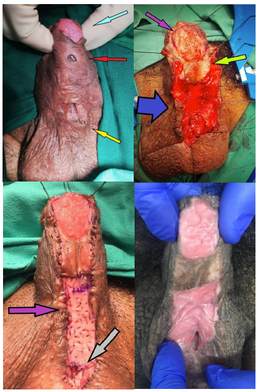 Fig. 11. Técnica de uretroplastía en etapas: a) Paciente con antecedente de hipospadias con 18 cirugías previas. Flecha calipso: injerto antiguo de mucosa oral. Flecha roja: fístula uretrocutánea. Flecha amarilla: fístula uretrocutánea y vellos saliendo de flap de escroto antiguo. b) Intraoperatorio. Flecha morada: se preserva injerto antiguo en glande. Flecha verde-amarilla: se preserva segmento de injerto cutáneo antiguo en tercio medio. Flecha azul: se reseca toda la neoplaca uretral antigua estenótica y con vellos. c) Flecha morada: reconstrucción de placa con injerto de mucosa oral. Flecha gris: “collar” de mucosa oral circunscribiendo neomeato transitorio. d) Aspecto a los 3 meses postoperatorios, con neoplaca uretral amplia y neomeato amplio.