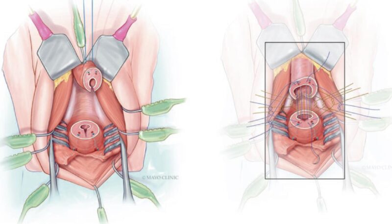 Fig. 12. Técnica de EPA: resección completa del segmento estrecho. Espatulación dorsal en cabo distal y ventral en cabo proximal. Presentación de suturas separadas dorsales y ventrales, 8 a 10 puntos en total. Anudar primero las dorsales bajo visión y luego las suturas ventrales. (Tomado de Joseph et al, 2020)27