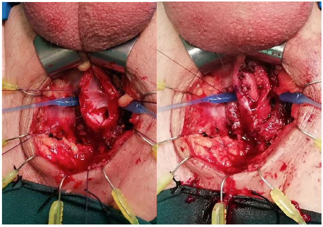Fig. 13. Técnica de onlay ventral: a) Uretrotomía longitudinal ventral y exposición de lumen. b) Sutura de injerto de mucosa oral a mucosa de uretra nativa (3 puntos separados en ápex distal y en ápex proximal; sutura corrida a ambos lados). Luego, se cierra esponjoso sobre el injerto (no mostrado en imágenes)