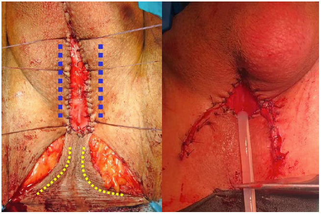 Fig. 14. Uretrostomía perineal: Incisión en lambda con uretrotomía longitudinal bulbar ventral y marsupialización de bordes a piel lateral (líneas azules) y flap de base posterior (líneas amarillas)