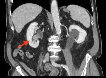 Fig. 1. Imagen axial de TC con CVUA en cáliz inferior derecho