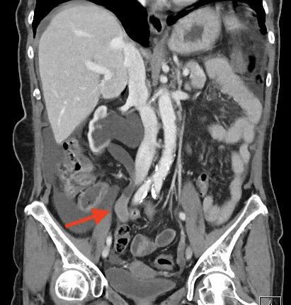 Fig. 2. Imagen axial de TC con CVUA en uréter derecho