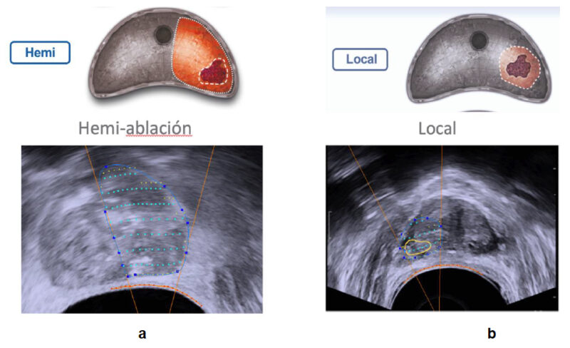Fig. 6. Estrategias de tratamiento: a: Hemi-ablación. b: Puramente focal.
