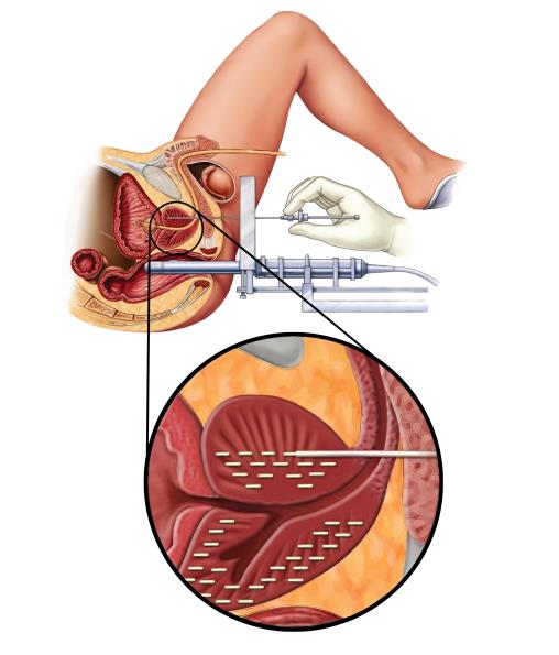 Fig1. Procedimiento de Braquiterapia