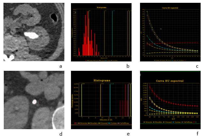Fig 1. (a) DECT (Revolution CT GSI, GE Healthcare ) adquisición axial sin contraste, protocolo PieloTC, que muestra cálculo coraliforme en riñón izquierdo. Se realiza ROI en centro del cálculo a analisar (b) Histograma que gráfica porcentaje de composición según número Z efectivo calculado para la litiasis (barras color rojo). En este caso los valores obtenidos se distribuyen mayoritariamente en torno al número Z efectivo conocido para ácido úrico (barra amarilla) (c) Curva espectral de Unidades de Hounsfield (HU), para diferentes valores de keV. La curva de color rojo muestra el comportamiento de nuestro cálculo, de morfología y pendiente similar a la curva conocida para ácido úrico (en color amarillo). (d) DECT (Revolution CT GSI, GE Healthcare) adquisición axial sin contraste, protocolo PieloTC, que muestra cálculo redondo en ureter proximal derecho. Se realiza ROI en centro del cálculo a analizar. (e) El histograma muestra que los valores obtenidos (barras rojas) se distribuyen mayoritariamente en torno al número Z efectivo conocido para oxalato de calcio (barra rosada). (f) La curva espectral de Unidades de Hounsfield (HU), muestra que la curva de color rojo de nuestro cálculo, es de morfología y pendiente similar a la curva conocida para oxalato de calcio (en color rosado).