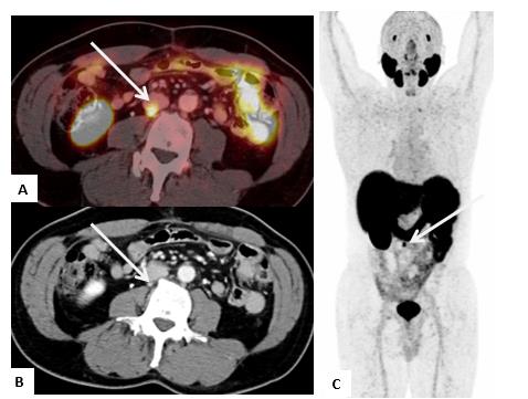 Fig. 6 Recidiva bioquímica en paciente con prostatectomía radical, PSA 1,16 ng/ml. PET/CT-PSMA imagen fusionada en A y MIP (maximum intensity projection) en C muestran adenopatía hipercaptante retrocava (flecha blanca) que se correlaciona con pequeña adenopatía subcentimétrica en la tomografía computada (flecha blanca en B).
