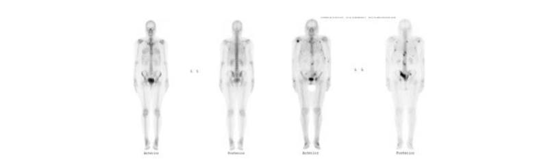 Fig, 8. Comparación entre un Cintigrama óseo normal y uno con metástasis óseas de cáncer de próstata.