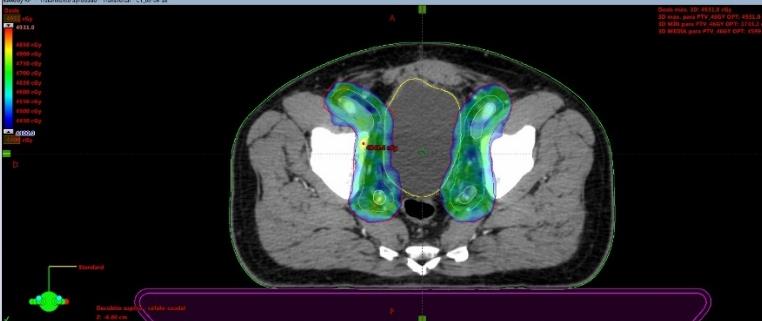 Fig. 1a. Técnica de IMRT (Radioterapia de intensidad modulada). Se observa como la conformación de la dosis terapéutica protege de manera segura los órganos de riesgo (OARS). La zona de color, muestra la dosis de radiacion terapéutica (46Gy) sobre las regiones ganglionares a nivel ilíaco interno, externo y obturatriz. Se evidencia así que las dosis llegan exclusivamente a la zona de interés, respetando la vejiga y el recto.