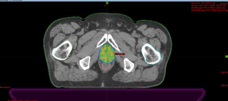 Fig. 1b. Técnica de IMRT (Radioterapia de intensidad modulada). La zona de color, muestra la dosis de radiación terapúetica (70Gy) sobre la próstata. Se evidencia que la dosis alta sólo llega sobre el target, respentado hacia posterior el recto.
