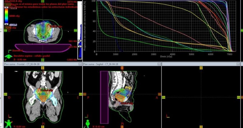 Fig. 1c. Técnica de IMRT (Radioterapia de intensidad modulada). Se observa en los colores las dosis de radiación sobre la pelvis (verde y azul, 46Gy) y sobre la próstata (naranjo, 70Gy). En el gráico, las líneas de colores corresponden a los órganos de riesgo (OAR) y los target, en donde se mide la dosis de radiación, en un volumen determinado que llega al OAR, para así saber que estaen rangos de buena tolerancia (ya predeterinados) y que las zonas target reciban al menos las dosis mínimas terapéuticas. Las dosis están en cGy (70Gy= 7000cGy).
