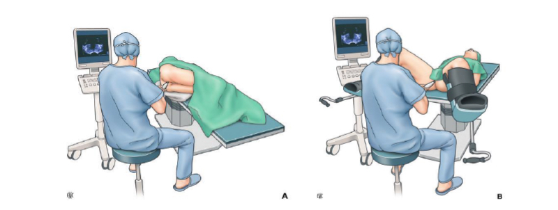 Fig. 2. Posición decúbito lateral (A) y de litotomía (B)