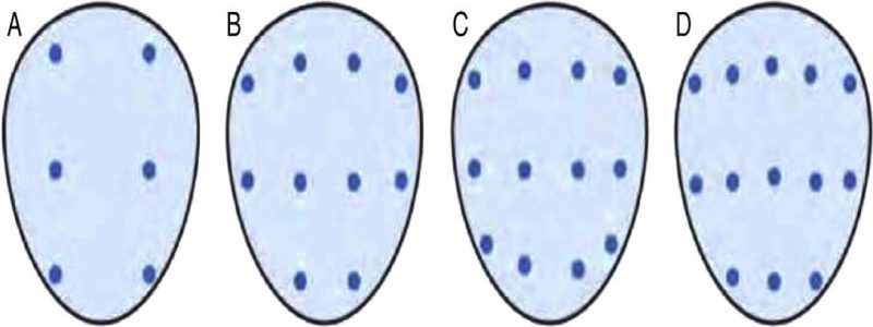 Fig. 3. Esquemas de biopsias. A. Biopsia por sextantes por Hodge et.al. B. Biopsia de 10 núcleos por Presti et al. C. Biopsia de 12 núcleos o doble sextante por Levine et al. D. Biopsia de 13 núcleos por Ezkew et al.