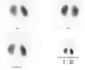 Fig. 11. Cintigrama renal estático con DMSA normal.