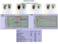 Fig. 10. Curvas de excreción con MAG-3