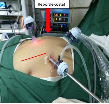 Fig. 11a. Posición sugerida de trocares para cirugía transperitoneal.