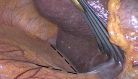 Fig. 17. Incisión peritoneal en “7” para abordaje suprarrenal derecho.