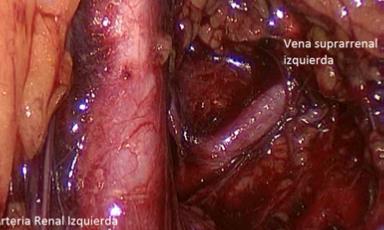 Fig. 18. Identificación de vena suprarrenal izquierda por vía retroperitoneal.