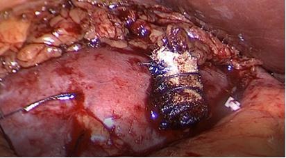 Fig. 27. Puntos hemostáticos con rollo de SurgicelR.