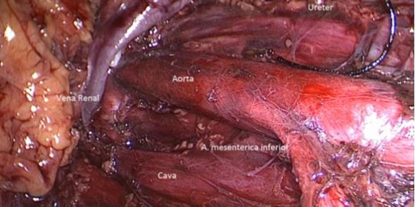 Fig. 31. Visualización de linfadenectomía retroperitoneal izquierda, después de la extracción de espécimen quirúrgico.