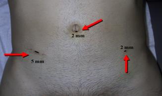 Fig. 32. Sitios de inserción de trocares con sutura intradérmica en varicocele