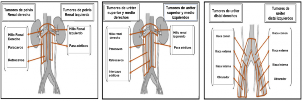 Fig. 5. Templados de linfadenectomía de acuerdo a la localización del CVUA (modificado de referencia #64)