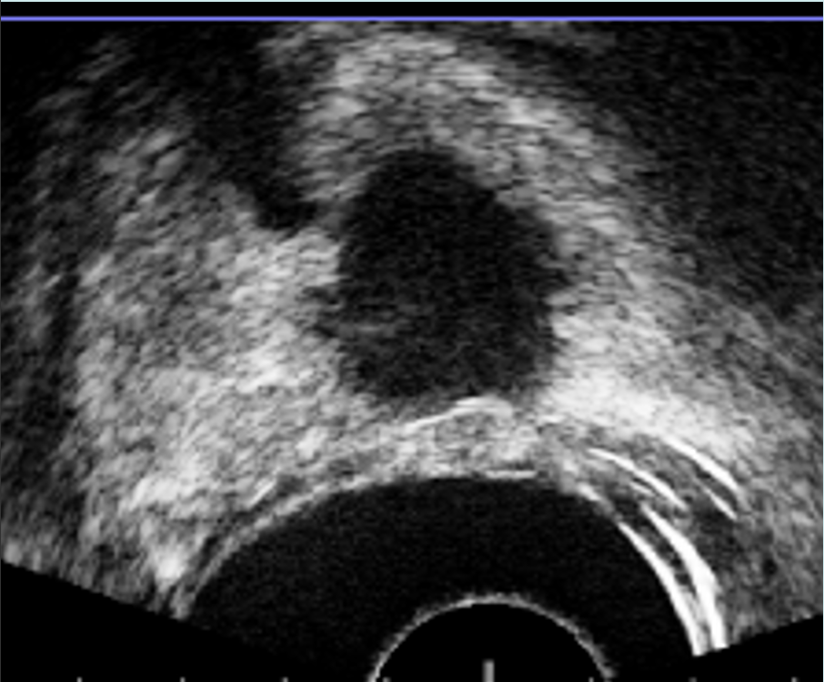 Fig. 5. Inyección de Sonovue® al finalizar el procedimiento. Se observa que la lesión tratada (flecha), está desvascularizada y no capta contraste.