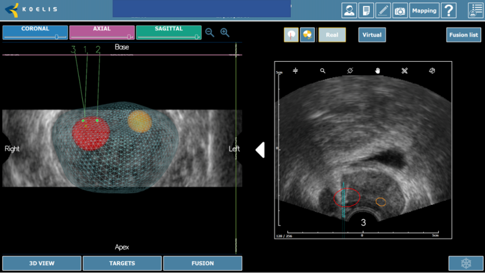 Fig. 8. Biopsia por fusión. Imagen de fusión con objetivo (izquierda). Tecnología organ based tracking para control del disparo (derecha)