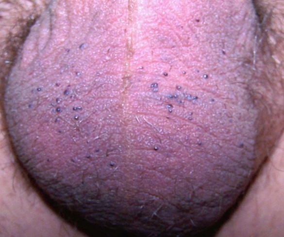  Fig,17. Angioqueratomas escrotales