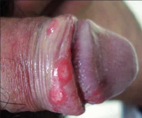 Fig. 8. Lesiones compatibles con Balanitis