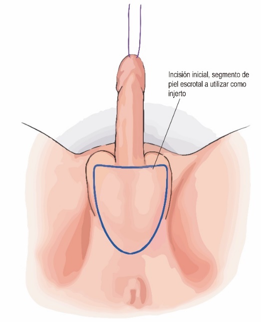 Fig. 3. Diseño del injerto de piel libre escrotal.