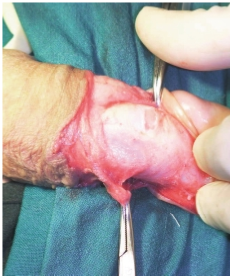 Fig. 4. Elipse de cuerpo cavernoso. (ref.77)