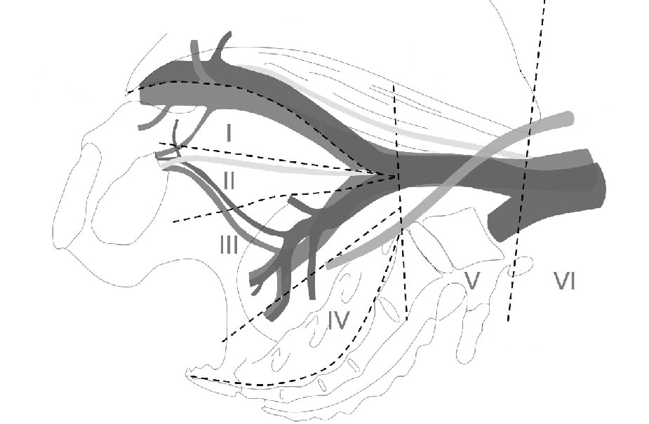 Fig.1. Templados de Linfadenectomia Pelviana (LDNP)
