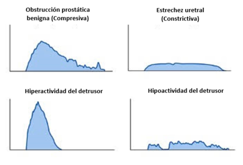 Fig. 2. Las distintas curvas de la uroflujometría nos pueden orientan a distintas etiologías.