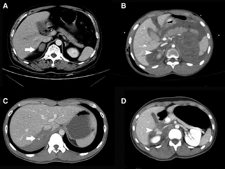 Fig. 6. Características del TGSR en TAC de abdomen: (A) hematoma ovalado de baja atenuación de la glándula suprarrenal derecha; Flecha: hematoma. (B) hematoma redondo con atenuación alta y abarrancamiento periadrenal de la glándula suprarrenal derecha. Punta de flecha: hematoma de alta atenuación. (C) destrucción de la glándula suprarrenal derecha con extravasación del contraste. Flecha: extravasación del contraste. (D) hematoma de alta atenuación oscureciendo la glándula suprarrenal derecha con extravasación del contraste. Punta de flecha: extravasación del contraste