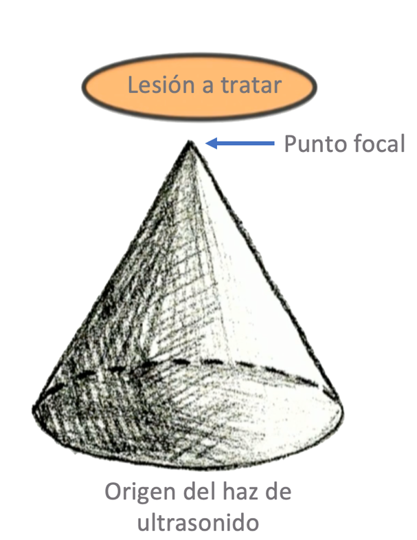 Fig. 1: Física del tratamiento con ultrasonido focalizado de alta intensidad (HIFU)