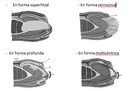 Fig. 2. Patrones de crecimiento de tumores peneanos Cubillas A: Am J Surg Path 2001, 25(20):1091-94