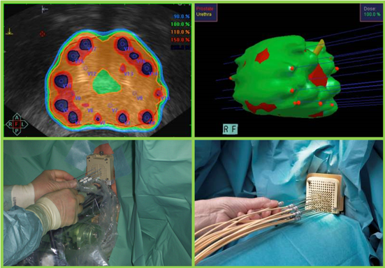 Fig. 4. Braquiterapia de Alta Tasa de Dosis. Se insertan agujas que se cargan posteriormente con iridio.