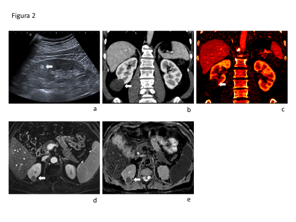 Fig. 2. (a) Angiomiolipoma renal derecho, menor a 10 mm, manifestado en ecografía como un pequeño nódulo hiperecogénico, bien delimitado, característica inespecífica que puede estar presente en CCR pequeños (flecha blanca). (b) Reconstrucción coronal de DECT con contraste en fase arterial que muestra lesión incidental renal derecha de densidad intermedia (flecha blanca). (c) Mapa de yodo realizado con DECT que muestra ausencia de contraste en la lesion incidental, compatible con quiste con contenido Bosniak II o IIf (flecha blanca). (d) RM de riñones con sustracción de fase T1 fat sat sin contraste a fase venosa que evidencia señal en la lesion renal derecha compatible con impregnación hipovascular de lesion sólida, en este caso CCR variante papilar (flecha blanca). (e) Mapa ADC (Coeficiente de Diffusion Aparente), de la lesion sólida renal derecha, CCR variante papilar, que muestra hiposeñal o bajo valor de ADC cuantificado, compatible con restricción a la diffusion de protones en lesion sólida hipercelular (flecha blanca).