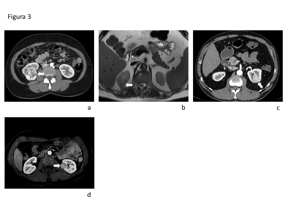 Fig 3 (a) RM, secuencia T1 axial con contraste en fase arterial que muestra CCR variante celulas claras en riñón derecho, presenta realce intenso y heterogéneo (flecha blanca) y que lavará en fases siguientes. (b) Secuencia T2 single shot axial (HASTE) de RM de riñones que evidencia un CCR variante papilar de baja señal T2 (flecha blanca). (c) TC de abdomen reconstrucción axial con contraste en fase arterial que muestra una lesion sólida del riñón izquierdo, con realce intenso y homogéneo en esta fase, que resulto ser un oncocitoma en la histología post quirúrgica (flecha blanca) indistinguible de CCRcc de pequeño tamaño. (d) RM de riñones adquisición T1 fat sat axial con contraste en fase arterial, evidenciando un nódulo sólido en riñón izquierdo, bien delimitado, con realce moderado y homogéneo en fase arterial, en la histología postquirúrgica demostró corresponder a CCR variante cromófoba (flecha blanca).