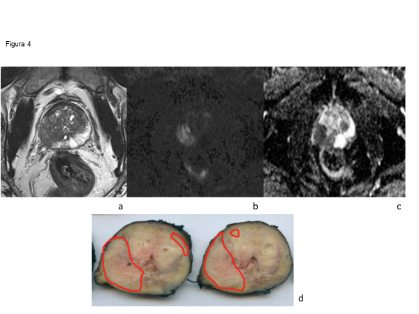 Fig 4. 67 años. PSA 7,3 ng/ml. TR sospechoso.Lesión nodular infiltrativa del LPD que contacta ampliamente la cápsula, con pérdida de definición de ella y abombada, lo que sugiere extensión extraprostática. Lesión PI-RADS 5 hipointensa en secuencia T2 (a), con restricción en difusión (b), baja señal en mapa ADC (c). (d) Pieza quirúrgica que demuestra extensión extraprostática (T3a) Gleason 4+5.