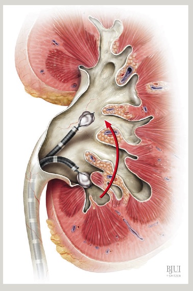 Fig.28 Reposicionamiento de la litiasis del polo inferior al polo superior