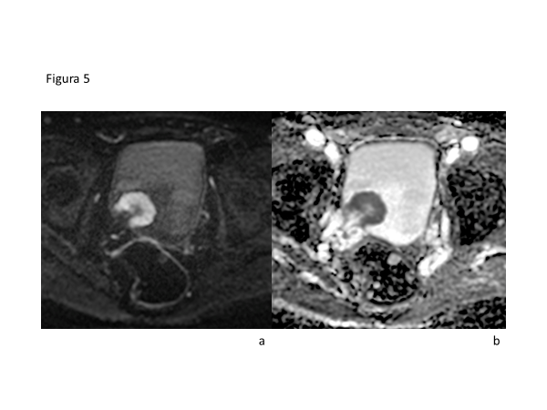 Fig 5. Lesión urotelial de implantación polipoidea de señal intermedia en secuencia T2 (a) y restricción en difusión con baja señal en mapa ADC (b). Presenta signo del “stalk sign” lo que sugiere indemnidad de la muscular. Lesión catalogada como VI-RADS 2 que se demuestra luego deresección con RTU. Carcinoma de células transicionales pT1 de alto grado.