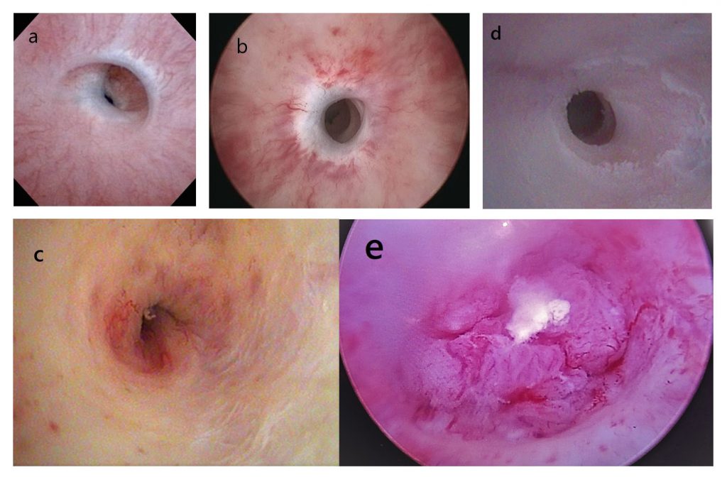 Fig. 4. Hallazgos en la cistoscopía. a) Estrechez unión penoescrotal con varios anillos. b) Estrechez bulbar media con moderada fibrosis. c) Estrechez unión bulbomembranosa con fibrosis severa y cambios post-radioterapia. d) Metaplasia escamosa y estrechez de uretra peneana. e) Hallazgo de tumor uretral durante estudio de posible estrechez uretral.