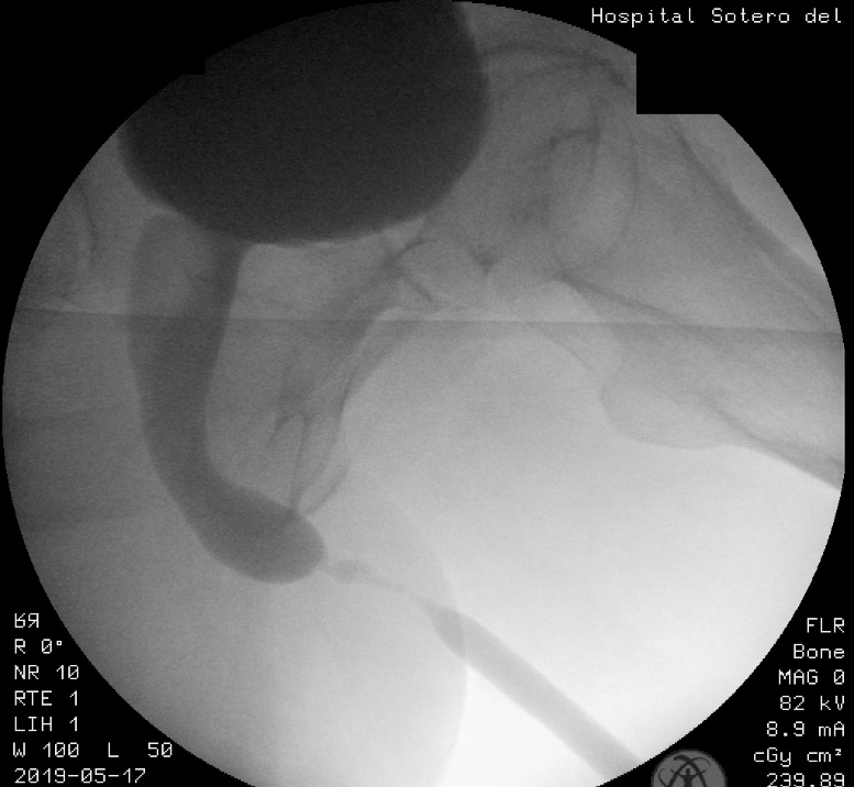 Figura 6. Uretrocistografía en fase miccional. Se aprecia el cuello, la uretra prostática, la uretra membranosa y la bulbar proximal abiertas, mientras se evidencia una estrechez crítica de la uretra bulbar media, con dilatación proximal a la estrechez.